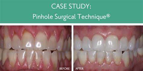 summerlin pinhole surgical technique
